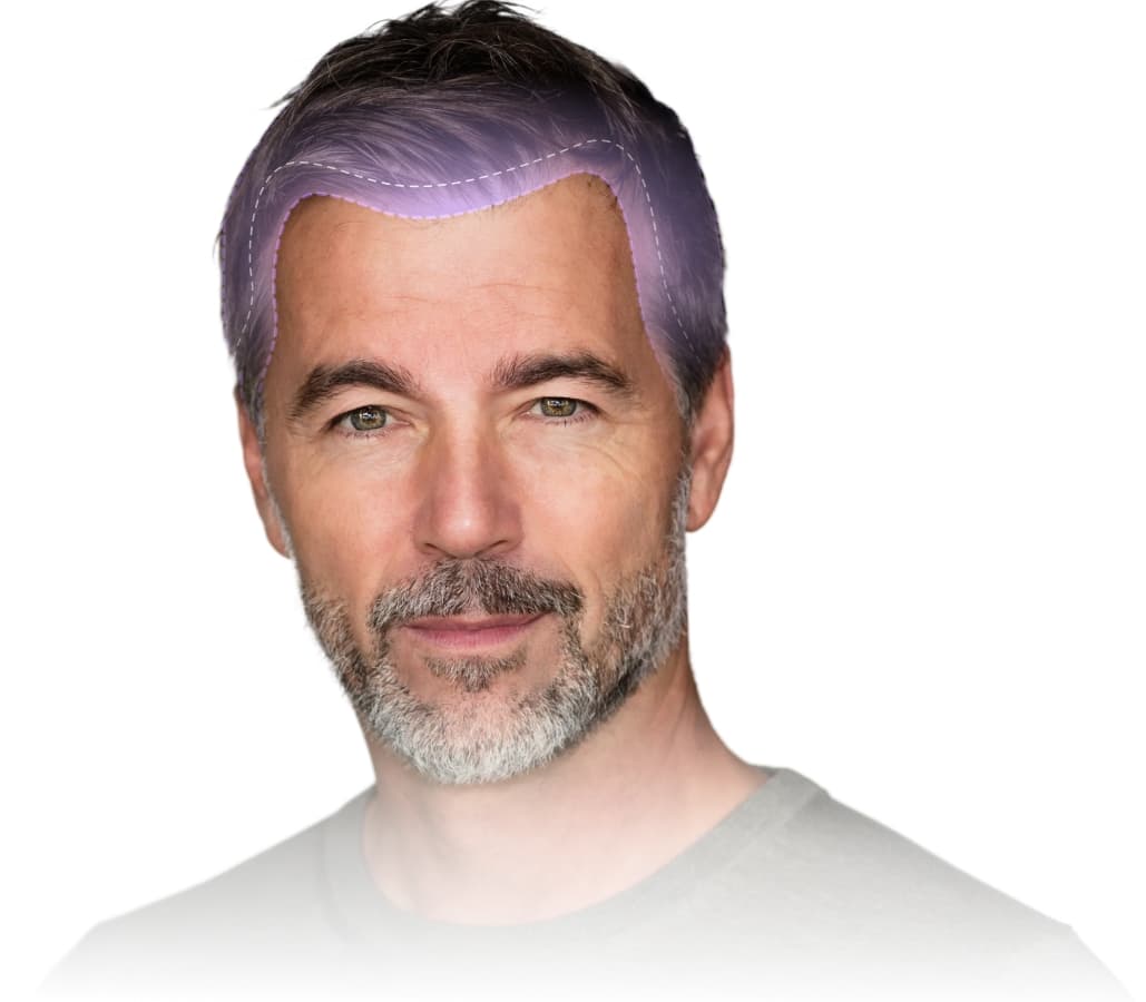 Hairloss AI scan result showing a hair density heatmap and Norwood stage
