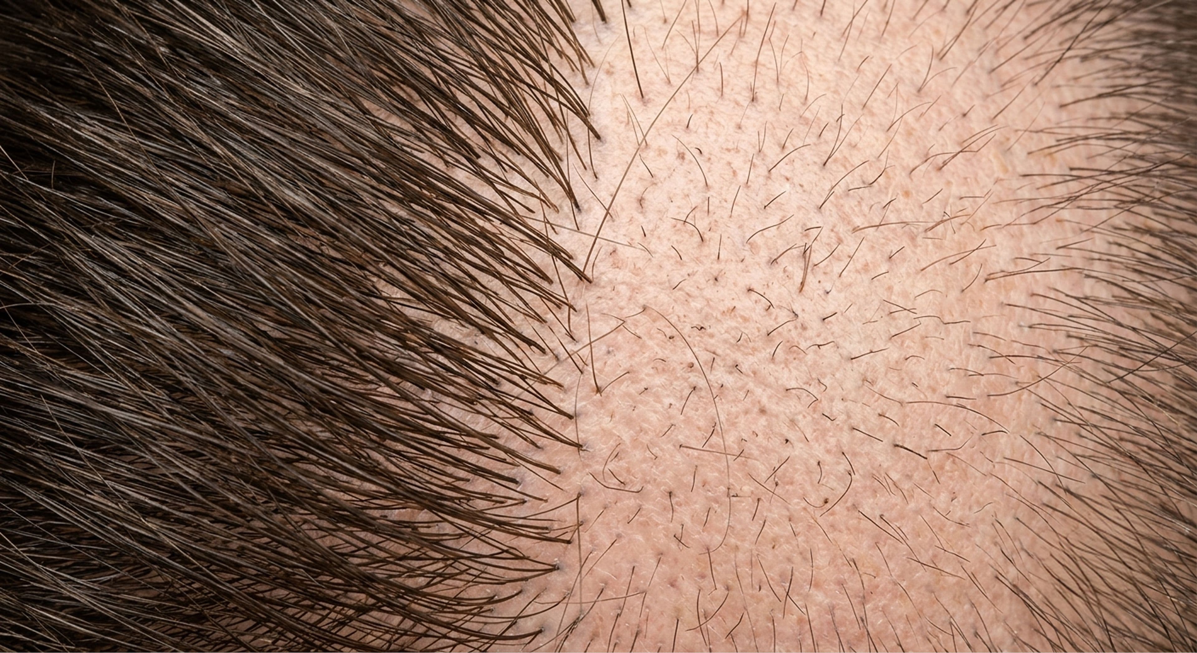 scalp showing follicle miniaturization